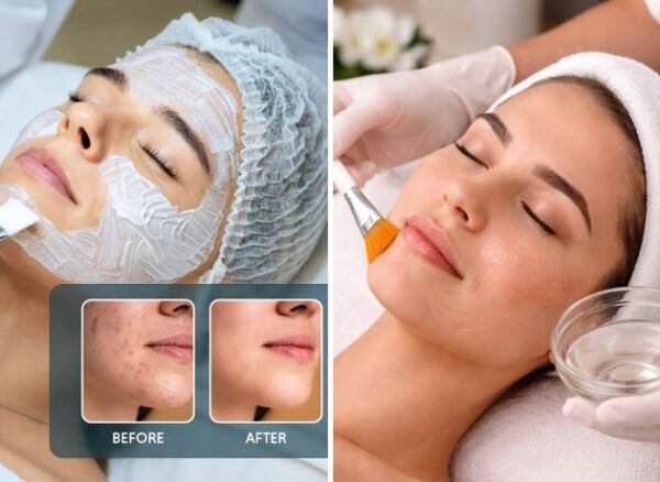 Skin Peels